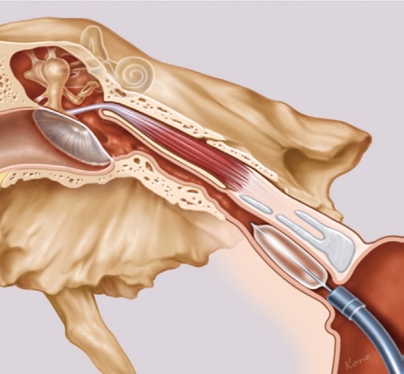 耳咽管氣球擴張成型手術02圖片來源SPIGGLEandTHEIS